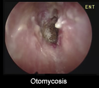 What is Sensorineural Hearing Loss?